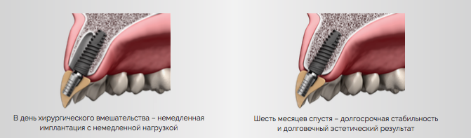 Физические нагрузки при имплантации зубов Физические нагрузки при имплантации зубов