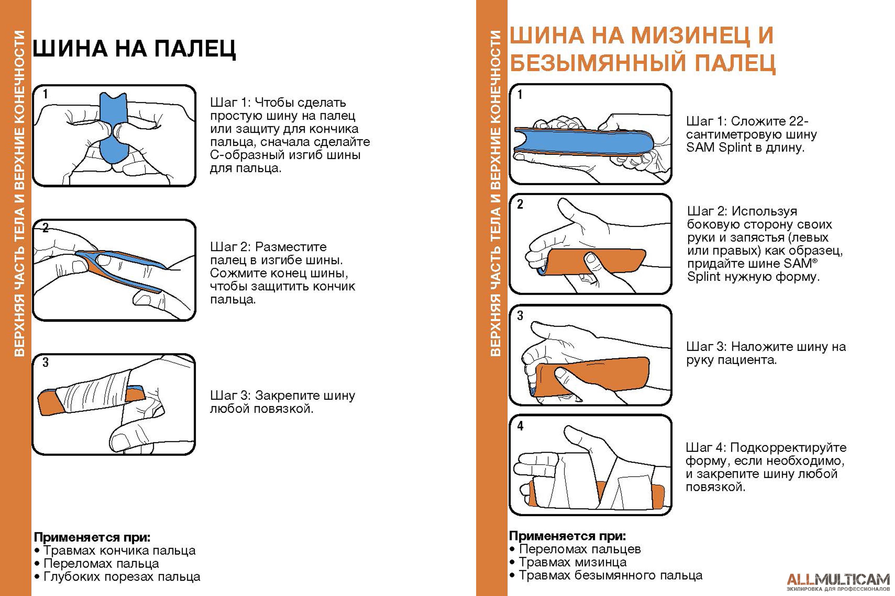 Наложение шины пальцев рук