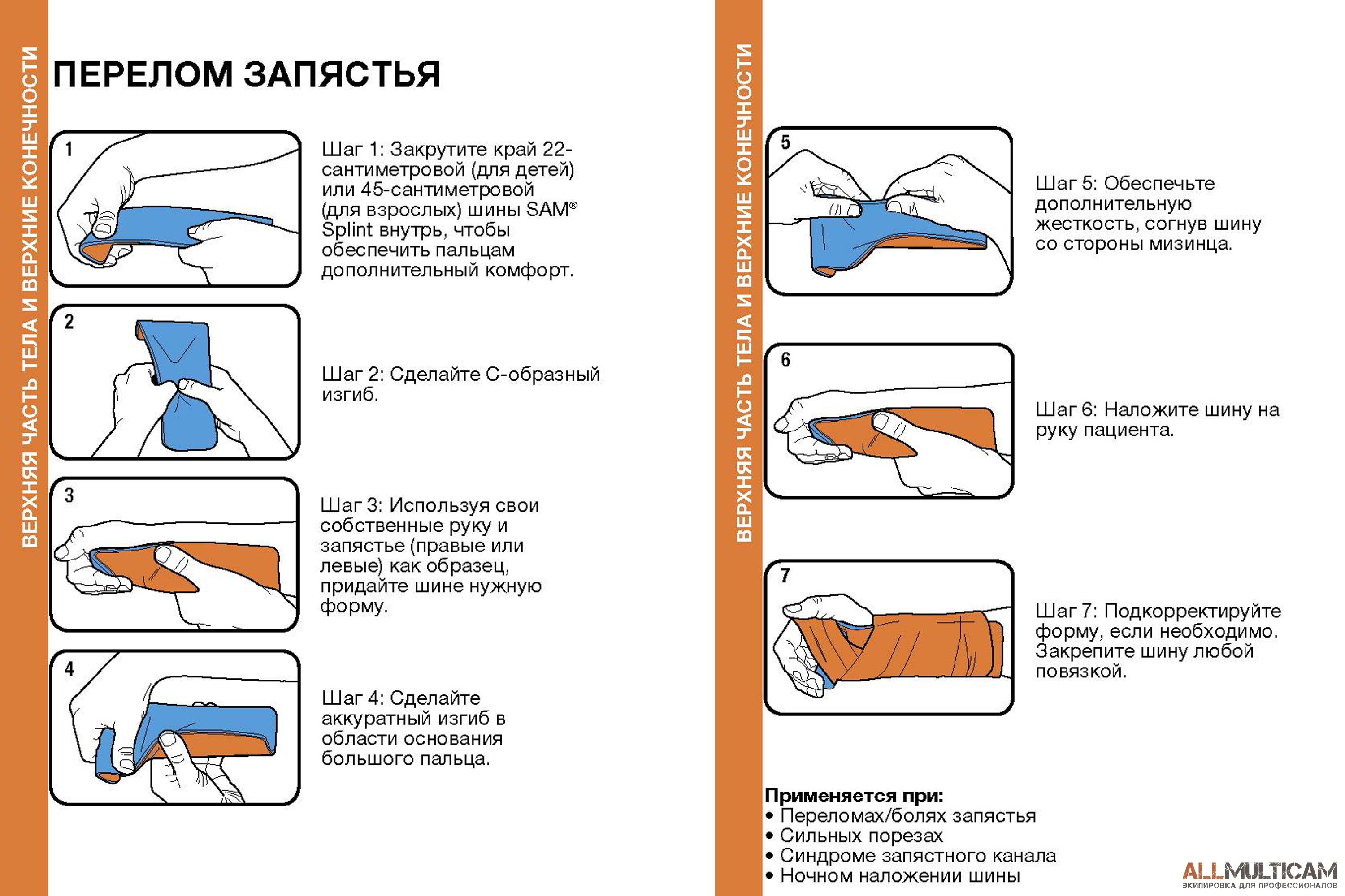 Перелом запястья