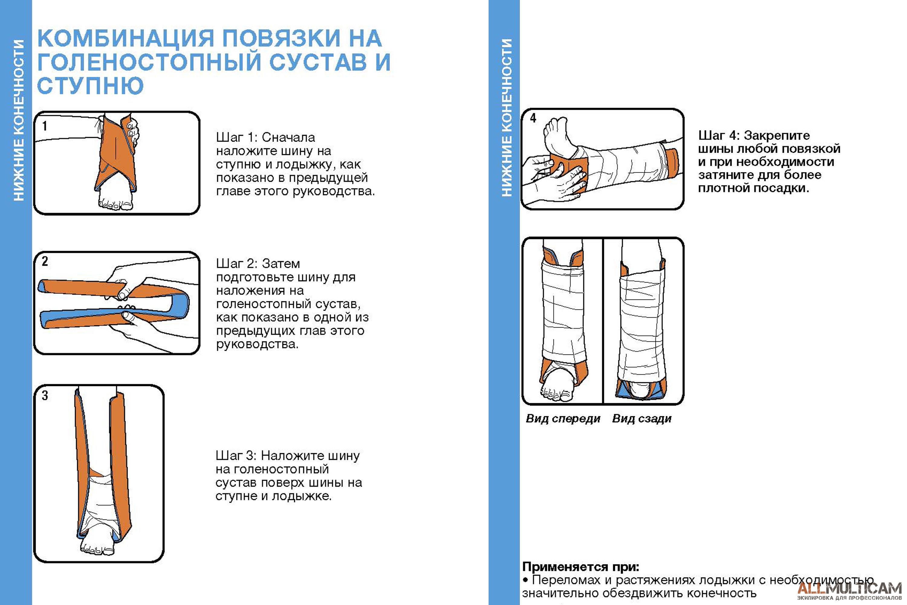 Схема наложения лечебных прокладок