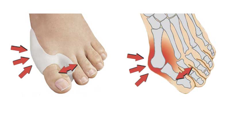 valgus_pro_works.jpg
