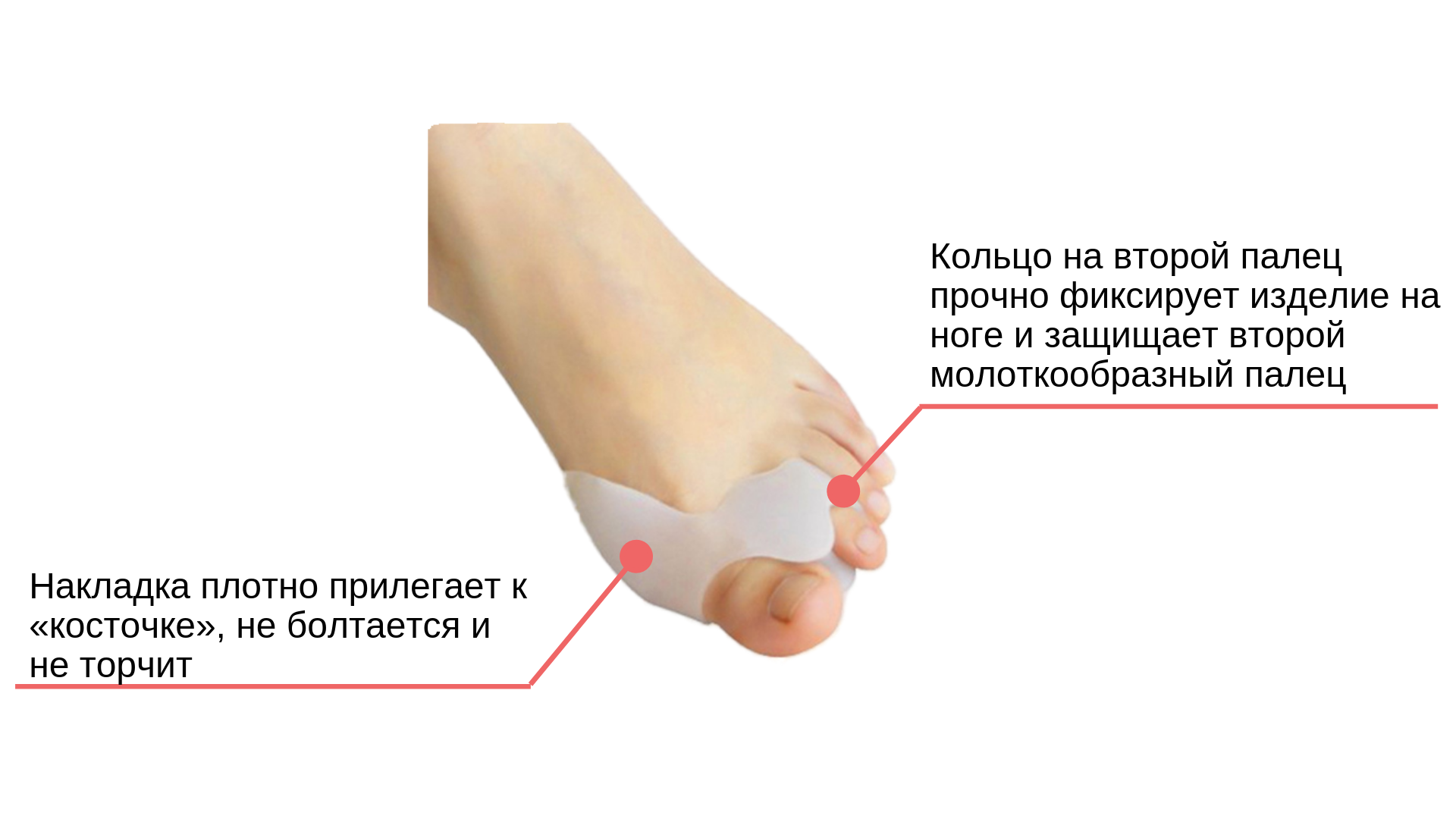 Косточка на ноге возле мизинца. Вальгус деформация большого пальца стопы. Поперечное плоскостопие вальгус. Почему растет косточка на ноге. Вальгусная деформация косточки.