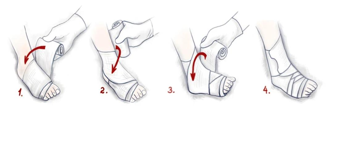 Как правильно наложить эластичный бинт на ногу. Фиксирующая повязка на голеностоп при растяжении связок. Бинтование голеностопа эластичным бинтом при растяжении. Перевязка стопы при растяжении. Фиксация голеностопа эластичным бинтом при растяжении.
