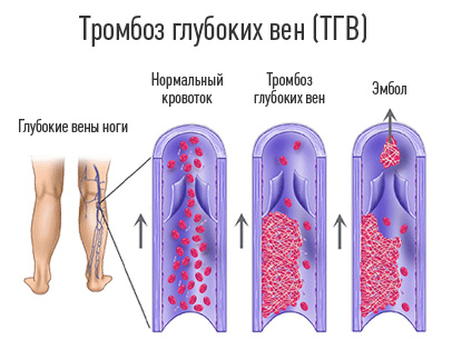 тромбоз.jpg