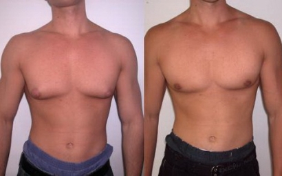 Gynecomastia.jpg